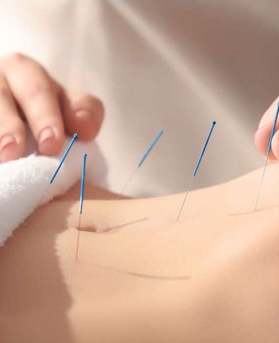 へそ周辺に鍼を打たれた女性